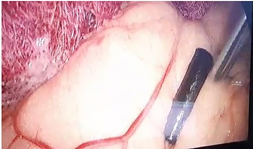 Intraoperative picture of the bullet in the liver.