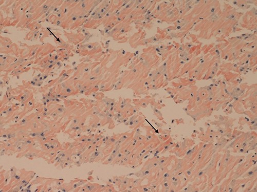 Liver core biopsies (Congo red, x20): the amorphous material in the sinusoids demonstrates salmon pink staining under standard light microscopy in keeping with amyloid deposition.