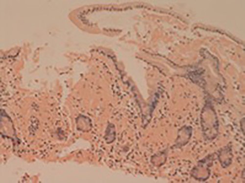 Small bowel mucosa (Congo red, x20): the substance is positive with Congo red stain in keeping with amyloid (salmon pink staining under standard light microscopy).