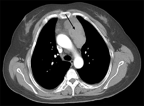Enhanced CT scan of the chest revealed an anterior mediastinal tumor (black arrow).
