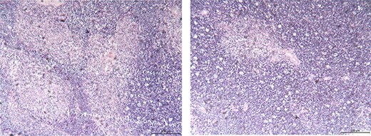 Histological findings of the surgical specimens; thymoma; (hematoxylin–eosin stain; original magnification ×100).