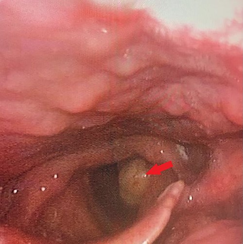 Flexible laryngoscopic examination of the larynx, showing left sided polypoidal mass.