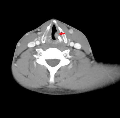 Axial contrasted CT image of larynx, showing left sided glottic versus supraglottic mass.