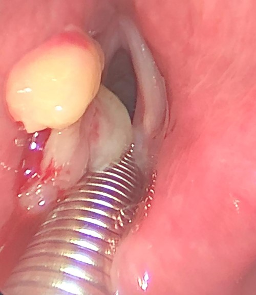 Intraoperative picture, showing left sided mass originated from left false vocal fold.