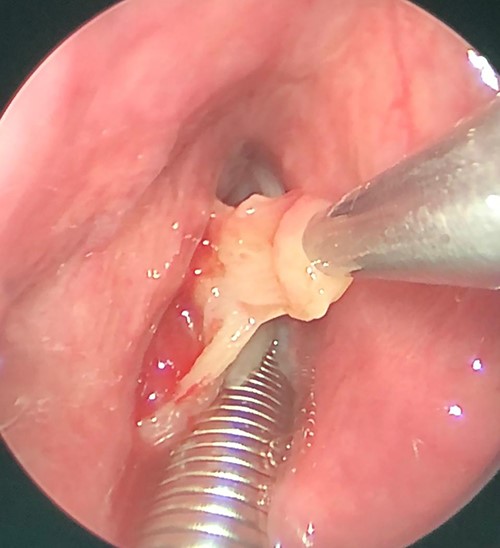 Excisional biopsy of left false vocal fold mass