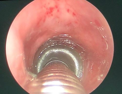 Intraoperative picture, showing clear subglottic area.