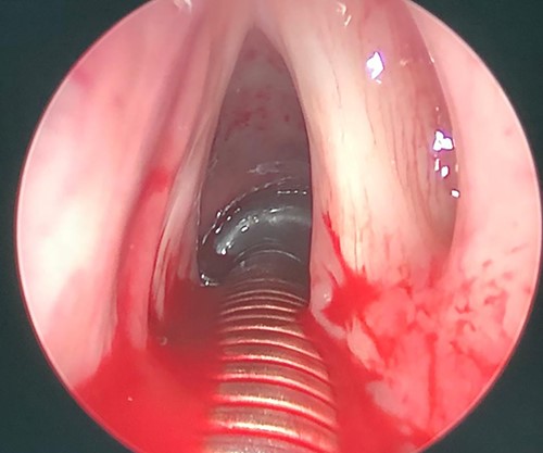 Intraoperative picture after complete excision of the mass.