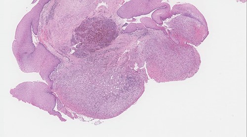 Polypoid squamous mucosa with ulceration and peripheral hyperplastic changes (original magnification: X40, H&E stain).