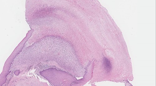 Surface ulceration with prominent fibrinoid necrosis (original magnification: X40, H&E stain).