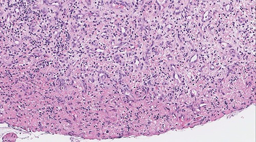 Vascular proliferation arranged as lobules with adjacent chronic inflammation (original magnification: X200, H&E stain).