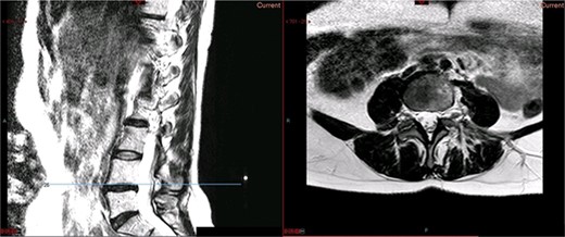 Preoperative MRI scan of the lumbar spine: preoperative MRI scan of the lumbar spine performed in October 2013, showing non-compressive disc degeneration at the L4/5 and L5/S1 vertebrae.