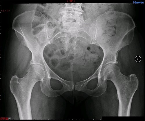 Preoperative X-ray of the pelvis: preoperative X-ray of the pelvis, performed in March 2014, showing no implants yet in place.