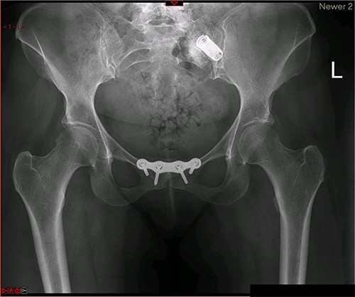 Postoperative X-ray of the pelvis following the first fusion surgery: postoperative X-ray of the pelvis, performed in November 2014 following the first fusion surgery, showing plating of the symphysis pubis and distraction arthrodesis of the left sacroiliac joint with DIANA implant.