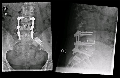 Postoperative X-ray of the pelvis following the second fusion surgery: postoperative X-ray of the pelvis, performed in January 2016 following the second fusion surgery, showing 360° (front and back) fusion of the L4/5 and L5/S1 disc space.
