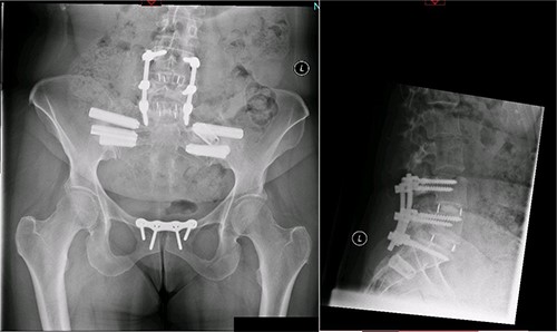 Postoperative X-ray of the pelvis following the third fusion surgery: postoperative X-ray of the pelvis, performed in March 2021 following the third fusion surgery, showing refusion of the left sacroiliac joint and primary fusion of the right sacroiliac joint with the SI-bone implant.