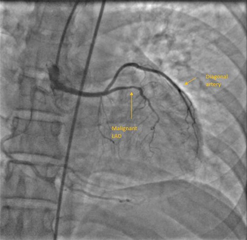 CAG with AAOC and malignant LAD course.
