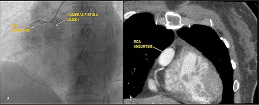 Giant RCA aneurysm with CCF. (a) CAG showing RCA aneurysm with RA blush; (b) RCA aneurysm in cardiac CT.