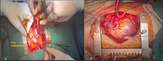 Intraoperative images. (a) RCA aneurysm on right angled forceps; (b) post RCA bypass with RSVG.