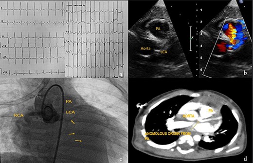 Investigations for diagnosis of ALCAPA. (a) ECG showing characteristic findings. (b) Echocardiography. (c) Aortic root angiogram showing coronary draining into PA. (d) CT angiogram.