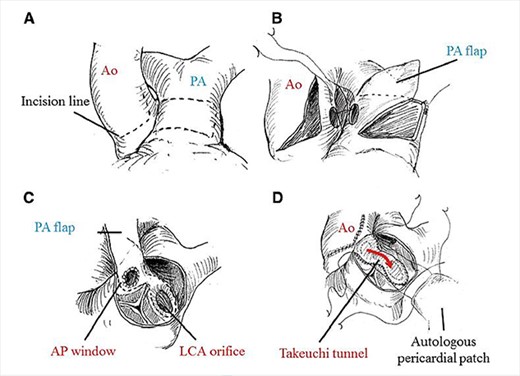 Technical details of Takeuchi technique. (A) aortotomy and incision of main PA (MPA). (B) creation of aorto-pulmonary window. (C) Pulmonary arterial flap suture (dashed line). (D) Reconstruction of MPA. Ao, aorta; PA, pulmonary artery; AP, aortopulmonary; LCA, left coronary artery. Required permission obtained from the respective journal.