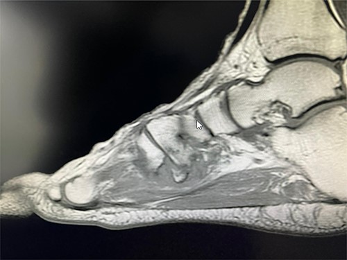 T1 sagittal view showing non-union of the avulsion fracture.