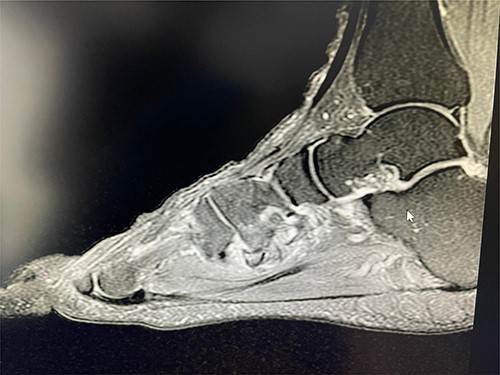 T2 sagittal view showing non-union of the avulsion fracture.