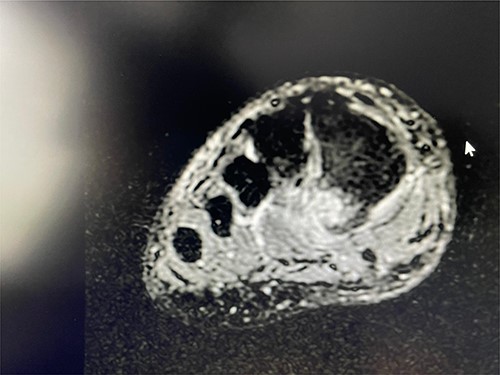 Coronal T2 view showing the non-union of the first metatarsal avulsion fracture.