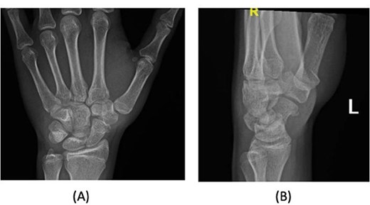 Initial injury posteroanterior and lateral radiograph demonstrating left wrist.