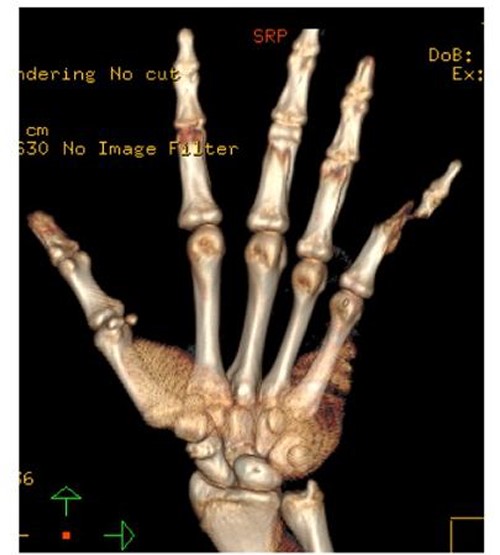 CT scan of the left wrist.