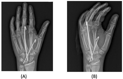 Posteroanterior and oblique radiographs taken intraoperatively after fixation, demonstrating proper alignment of hardware.
