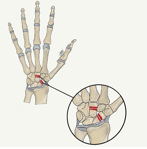 A medical illustration demonstrates scaphocapitate fracture.