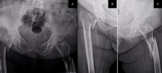 A. Anteroposterior pelvis radiograph evidencing a left subtrochanteric (AO:32-B2a) and a right intertrochanteric femur fracture (AO:31-A2.3). B. Radiograph of the right hip without any criteria of fracture instability. C. Radiograph of the left hip showing a simple wedge pattern of fracture.