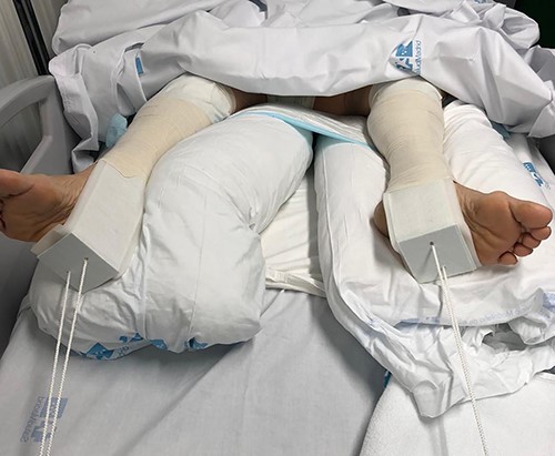 Patient immobilization in the emergency department: each lower limb was temporarily immobilized with a 3-kg skin traction.