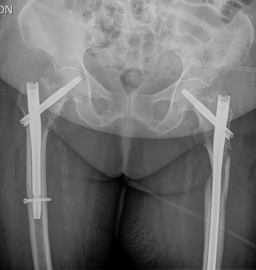 Postoperative anteroposterior pelvis radiograph: The left subtrochanteric fracture was first reduced with percutaneous assistance and synthesized with a reamed intramedullary long Gamma3 nail (340 mm,125°, Stryker®) with cephalic dynamic locking screw and two static distal locking screws. Then, after closed reduction, the right intertrochanteric fracture was fixated with a non-reamed short Gamma3 nail (180 mm,125°, Stryker®) with cephalic and distal dynamic locking screws.