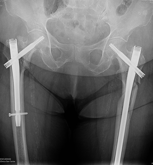 Radiological evaluation on follow-up at 1 year. Pelvis anteroposterior radiograph view showing signs of consolidation, without evidence of loss of reduction or implant failure.