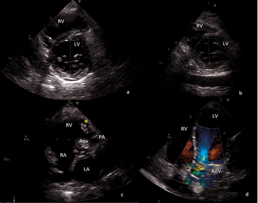 Transthoracic echocardiography images. (a) Preoperative short axis view of left ventricle. End-diastolic left ventricle diameter of 68 mm. (b) Postoperative short axis view of left ventricle. End-diastolic left ventricle diameter of 43 mm. (c) Sizable vegetation (yellow asterisk) of about 4 cm provoking right ventricular outflow obstruction. (d) Four-chamber view, showing severe aortic regurgitation. AoV aortic valve; LA left atrium; LV left ventricle; PA pulmonary artery; RA right atrium; RV right ventricle.