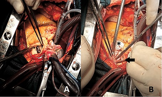 Perioperative images showing (A) sizable PV vegetation (asterisk) (B) pulmonary bioprosthesis (arrow) and pulmonary artery enlargement using synthetic patch (asterisk).