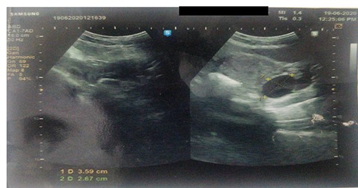 Ultrasound showing a well-defined tubular cystic structure with clear contents in the right inguinal canal up to labia majora measuring 5 cm × 3.5 cm × 5 cm with a volume of 50–60 ml.
