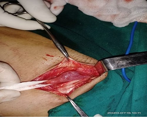 At surgery, through an inguinolabial incision, the cyst was dissected by blunt and sharp dissection from a round ligament in the inguinal canal; the neck of the sac was extending up to a deep ring.