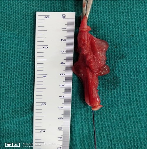 Showing sac measured about 5 cm.