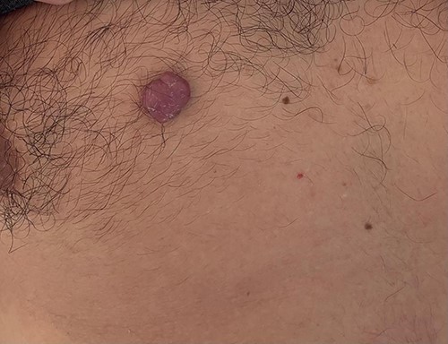 Dermal nonneural granular cell tumor presenting as a non-ulcerated polypoid skin nodule of the front side of the chest wall.