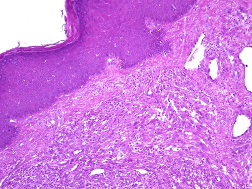 Diffuse infiltrate of polygonal cells (magnification at ×100).