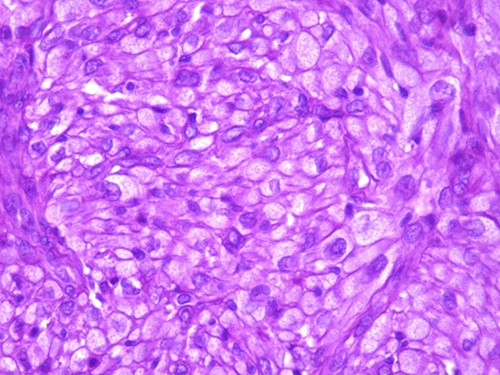 The tumor is composed of epithelioid cells with abundant granular cytoplasm and vesicular nuclei (magnification at ×400).