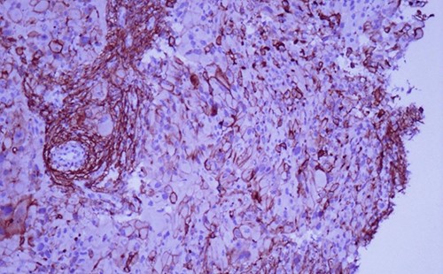 Immunohistochemistry reveals positivity for CD 10 (magnification at ×400).