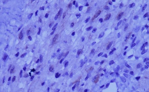 Immunohistochemical staining for ALK is weak and focal (magnification at ×400).