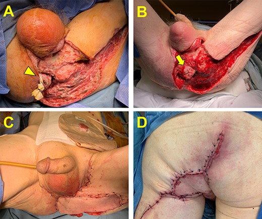 Management of the perineal wound. (A) Perineal wound upon transfer to our hospital following two initial debridements. A small skin bridge is encircled by a Penrose drain and connects the remaining perianal skin and the anus (arrowhead). (B) The perineal wound following complete infectious control and negative pressure wound vac therapy. Additional debridement was required and resulted in a free-floating anus (arrow). (C and D) The perineal wound following oncologic resection and flap reconstruction. Panel C is the anterior view, and Panel D is the posterior view.