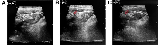 The abdominal US evidences a thickened appendix with circular protrusion at its distal tip (A). Periappendicular collection is visible (B–C, red arrow indicates the appendix).