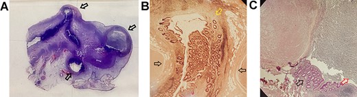 The histological section indicates the presence of three diverticula (A): the more distal one, with an abscess inside the lumen, of 9 mm and the other two (distal appendix) of 6 and 4 mm in diameter (black arrows indicate the diverticula). (B) The protrusion of the mucosa (pointed in yellow) through the muscular layer (pointed in black) in the bigger diverticulum. (C) The abscess in the largest diverticulum is pointed in red (black arrow indicates the mucosa).