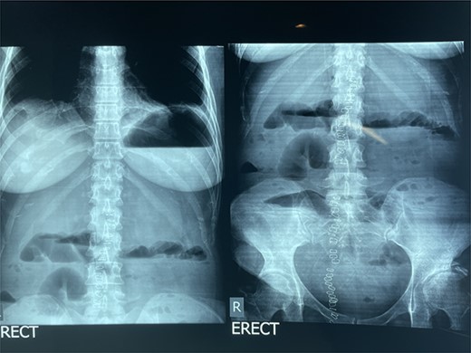 Erect abdominal X-ray showing air under the diaphragm.
