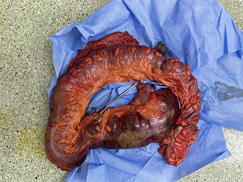 Gross image of resected colon revealing gangrenous distended cecum.